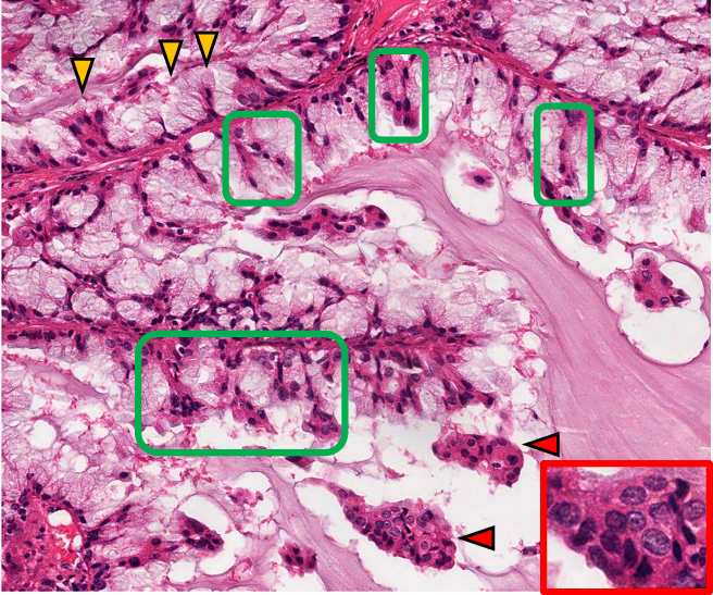 High-power H&E of mucinous adenocarcinoma