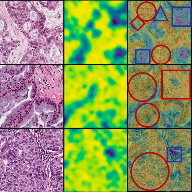 Tumor patches with attention maps from the ALK screening model