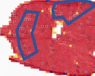 HipoMap patch probability map over a stomach adenocarcinoma slide, patient who survived 1 month
