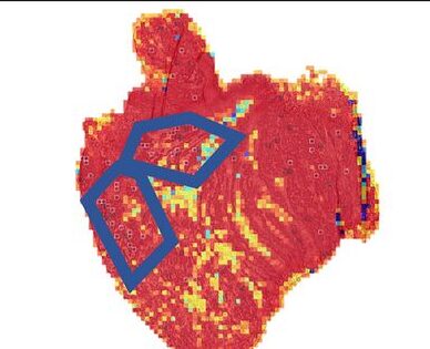 HipoMap patch probability map, patient who survived 53.1 months