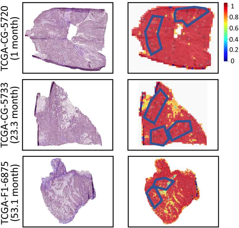 Slides, patch probability maps and HipoMaps for three stomach cancer patients