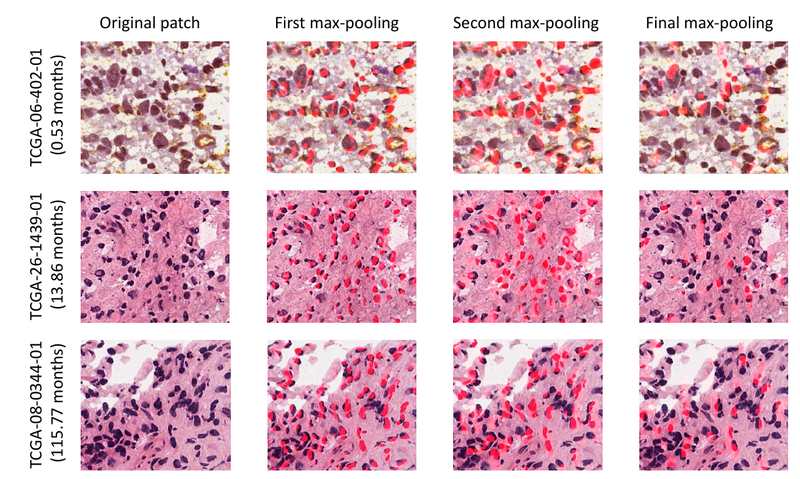 Glioblastoma H&E patches with survival-relevant regions highlighted
