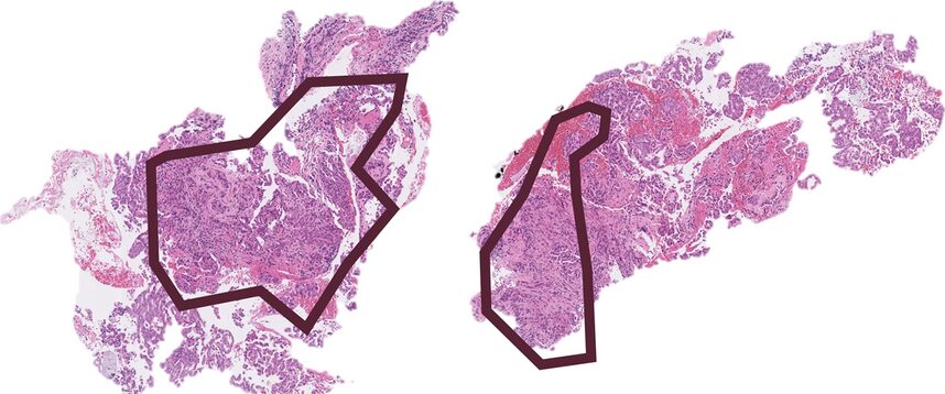 Whole-slide H&E scan of lung adenocarcinoma with annotated regions
