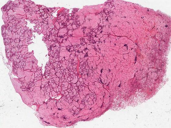 Low-power H&E scan of a mucinous lung tumor