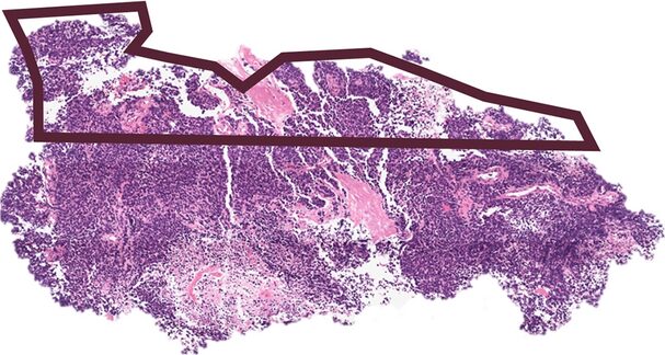 Whole-slide H&E scan of small cell lung cancer with annotated region